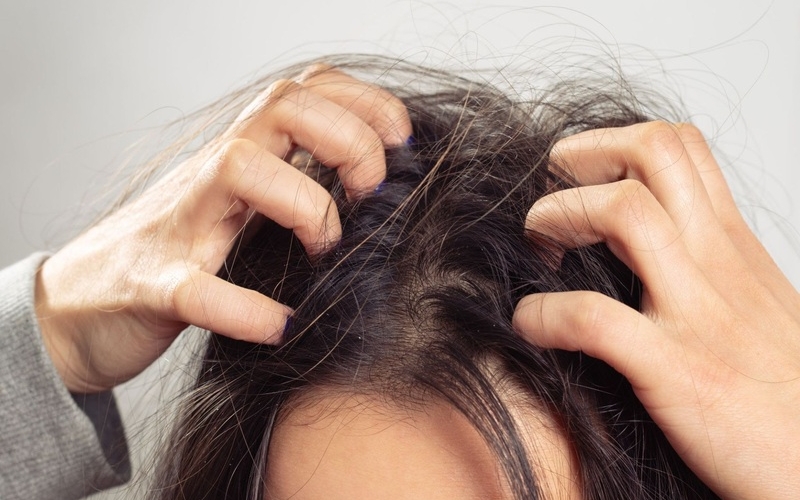 5 nguyên nhân gây ngứa da đầu và cách trị dứt điểm tại nhà