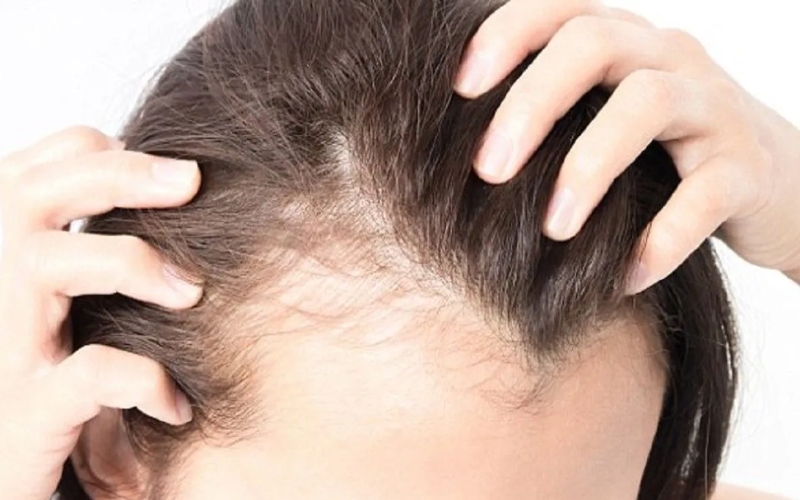 5 nguyên nhân gây ngứa da đầu và cách trị dứt điểm tại nhà