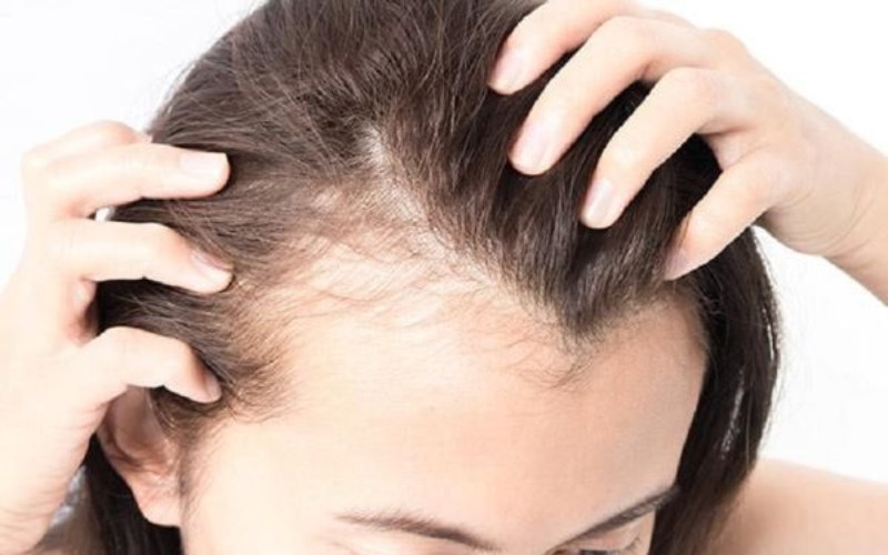 Dấu hiệu hói đầu sớm và giải pháp kích thích mọc tóc từ Gừng