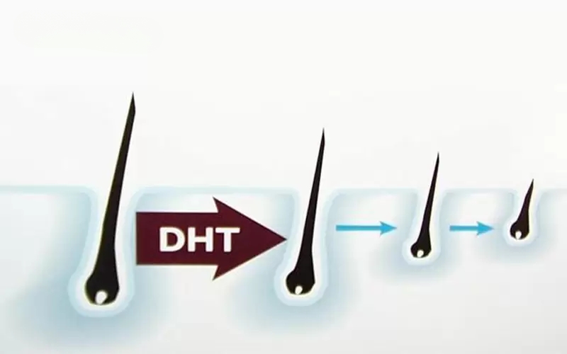 Dấu hiệu hói đầu sớm và giải pháp kích thích mọc tóc từ Gừng