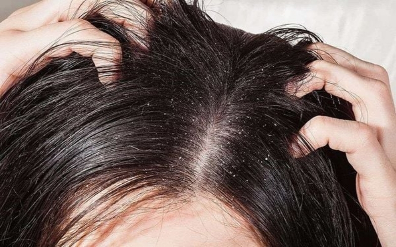 Dấu hiệu nhận biết nấm da đầu và cách trị dứt điểm bằng thảo dược