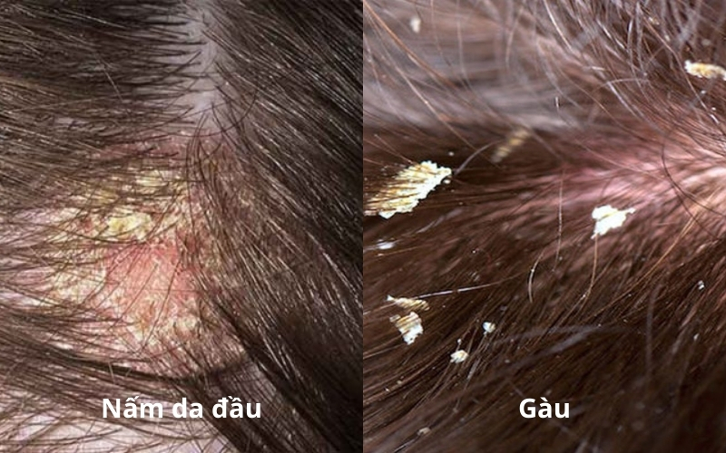 Dấu hiệu nhận biết nấm da đầu và cách trị dứt điểm bằng thảo dược