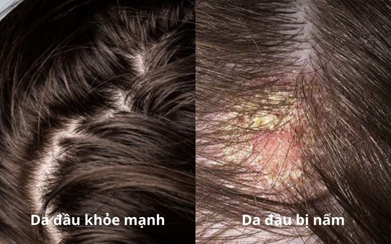 Dấu hiệu nhận biết nấm da đầu và cách trị dứt điểm bằng thảo dược
