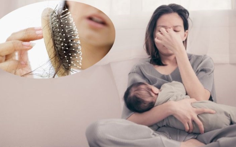 Rụng tóc sau sinh: nguyên nhân và cách khắc phục an toàn cho mẹ bỉm